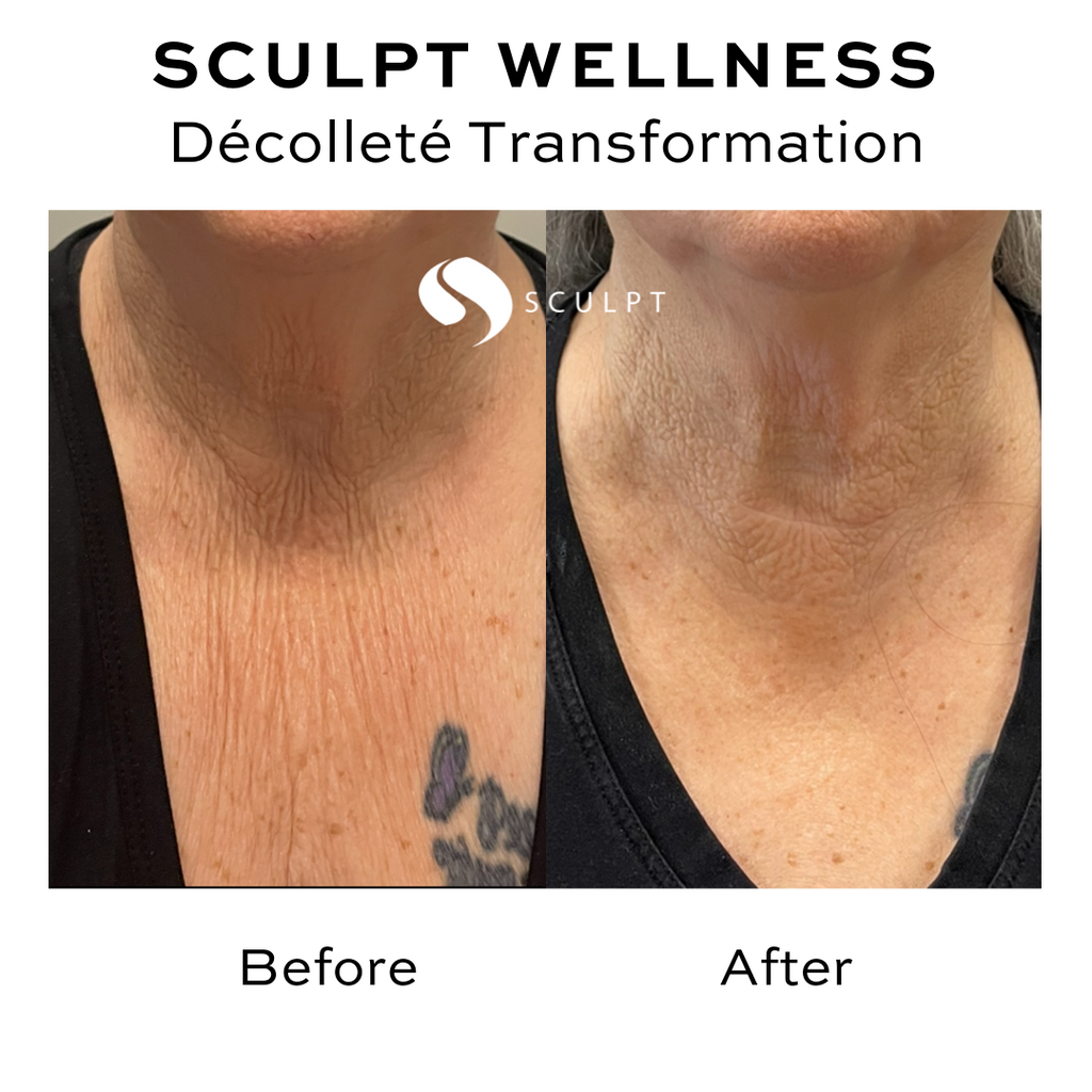 4 CryoThermal Facials (T-Shock) Face/Neck or Neck/Declotte