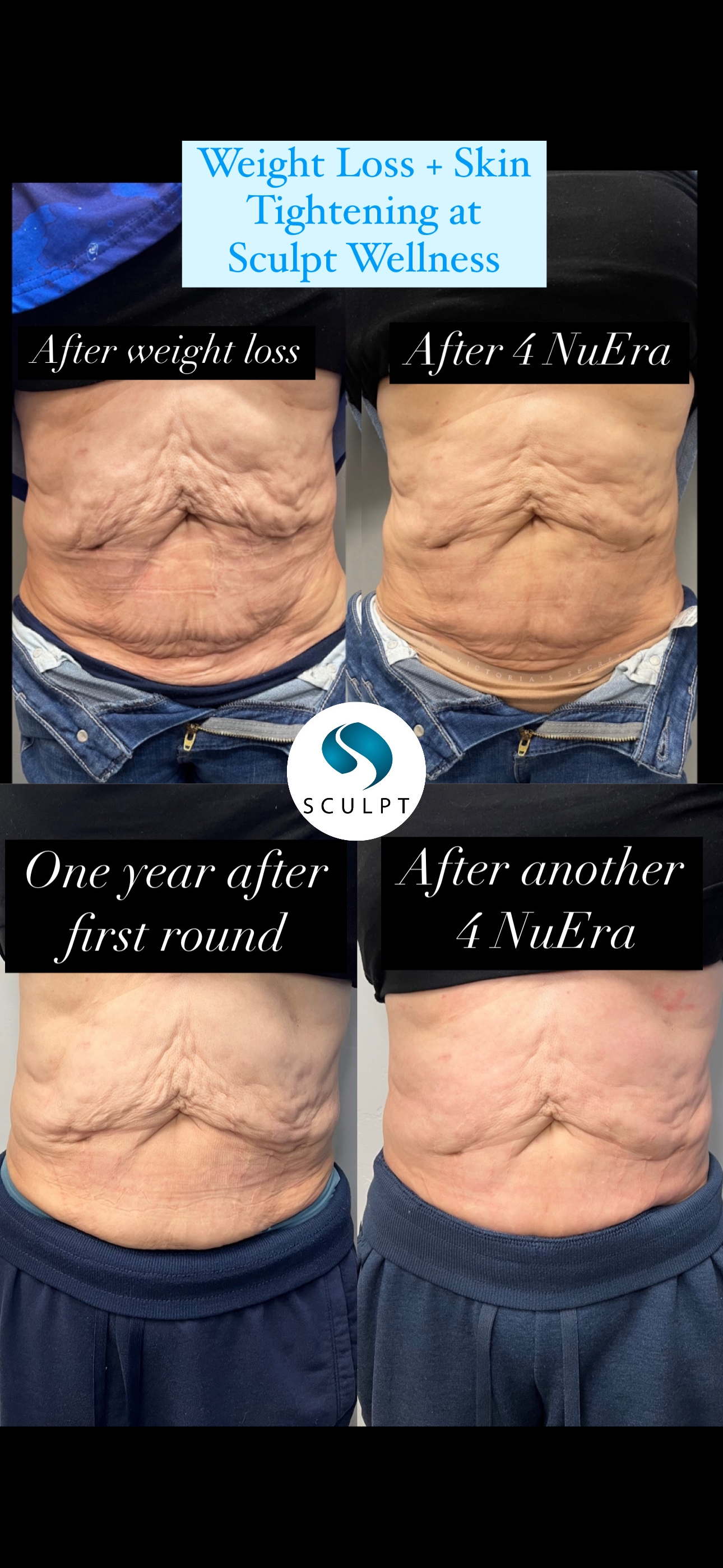 Skin Tightening/Smoothing OR Cellulite Smoothing Package