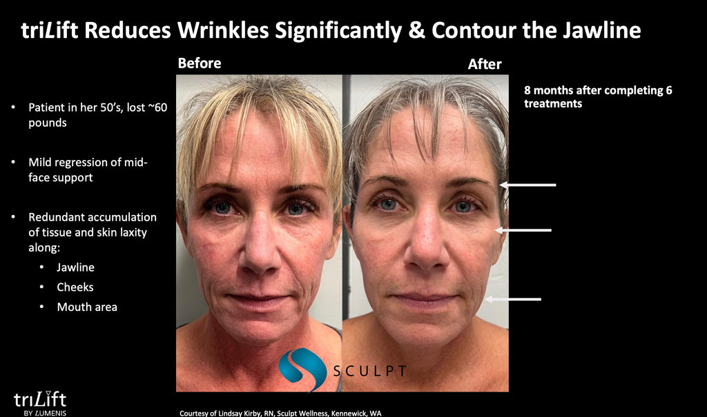 TriLift Full Package