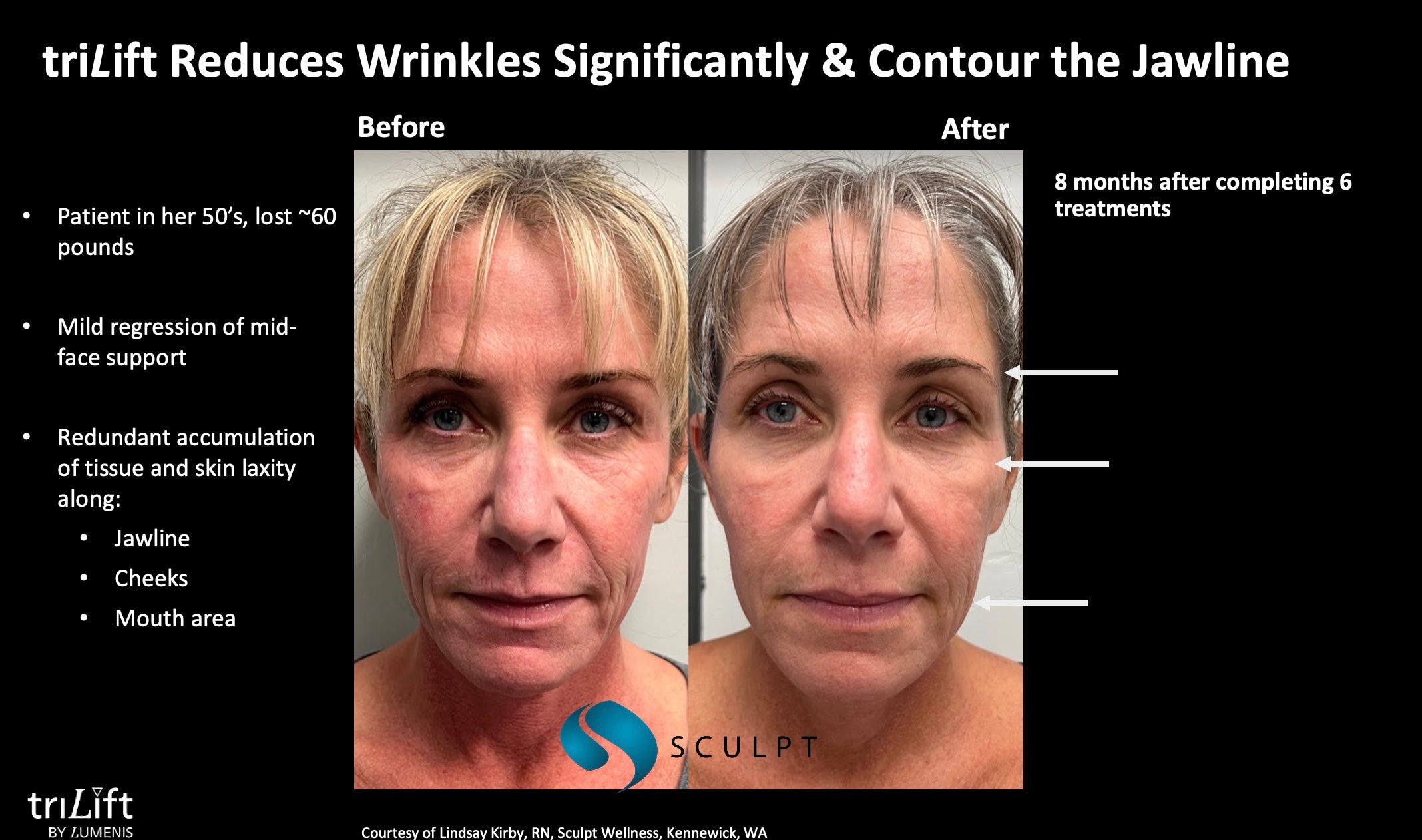 TriLift Full Package