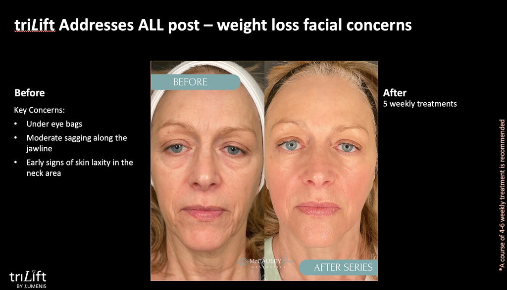 TriLift Full Package