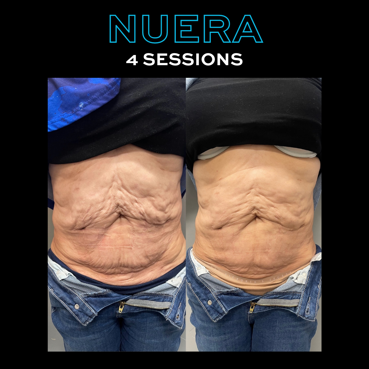 Skin Tightening/Smoothing OR Cellulite Smoothing Package