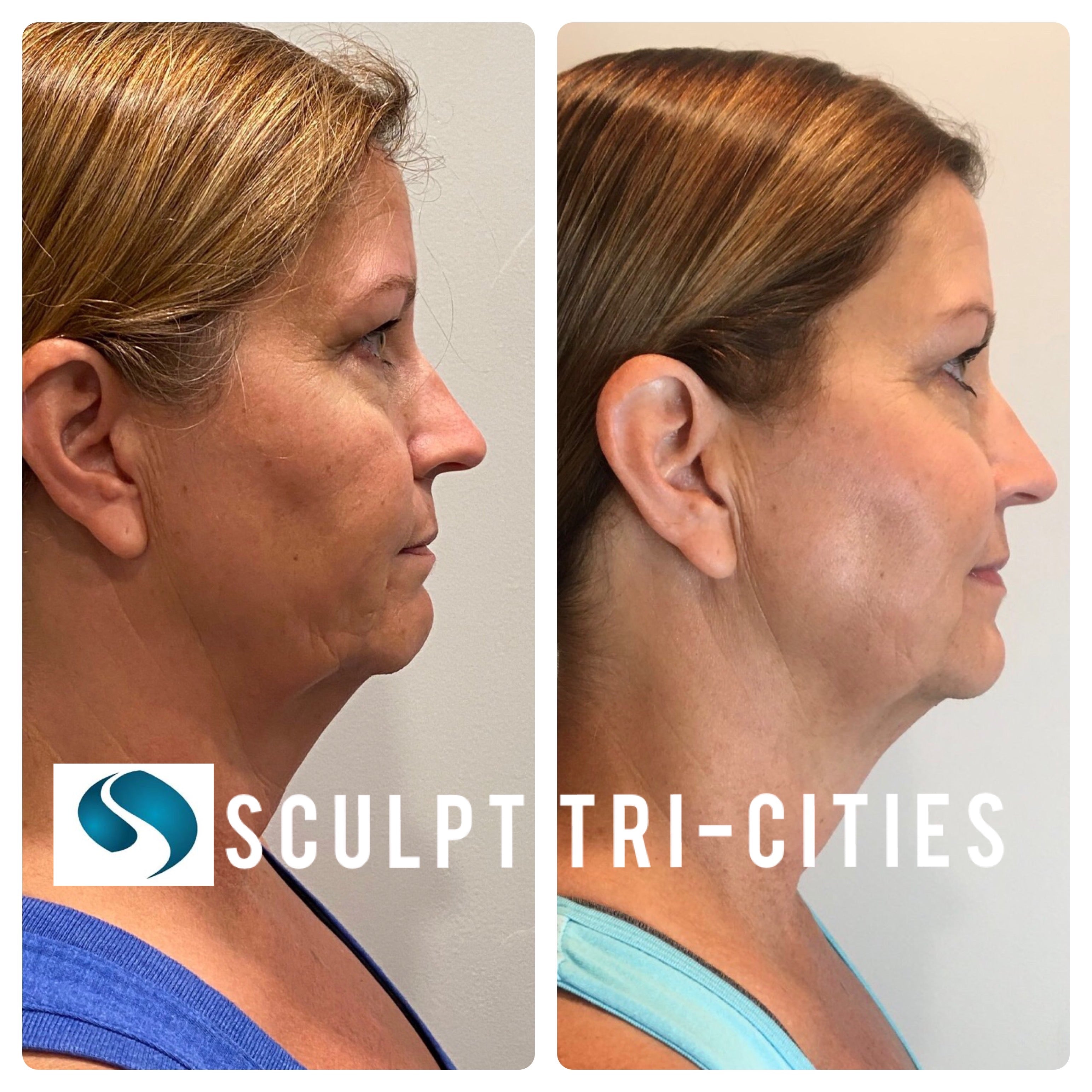 4 CryoThermal Facials (T-Shock) Face/Neck or Neck/Declotte