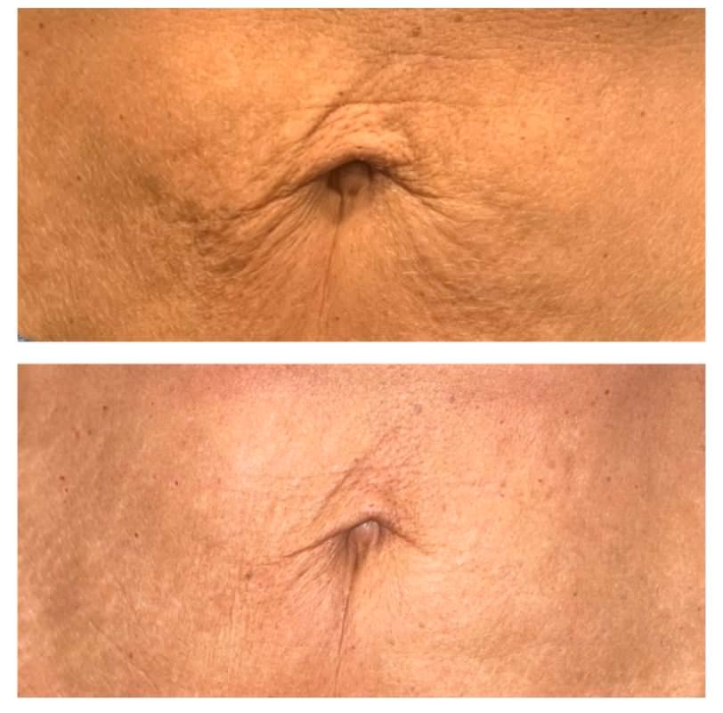 10 Body Thermal Sculpting (T-Schock). DEAL OF THE YEAR!