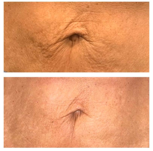 10 Body Thermal Sculpting (T-Schock). DEAL OF THE YEAR!