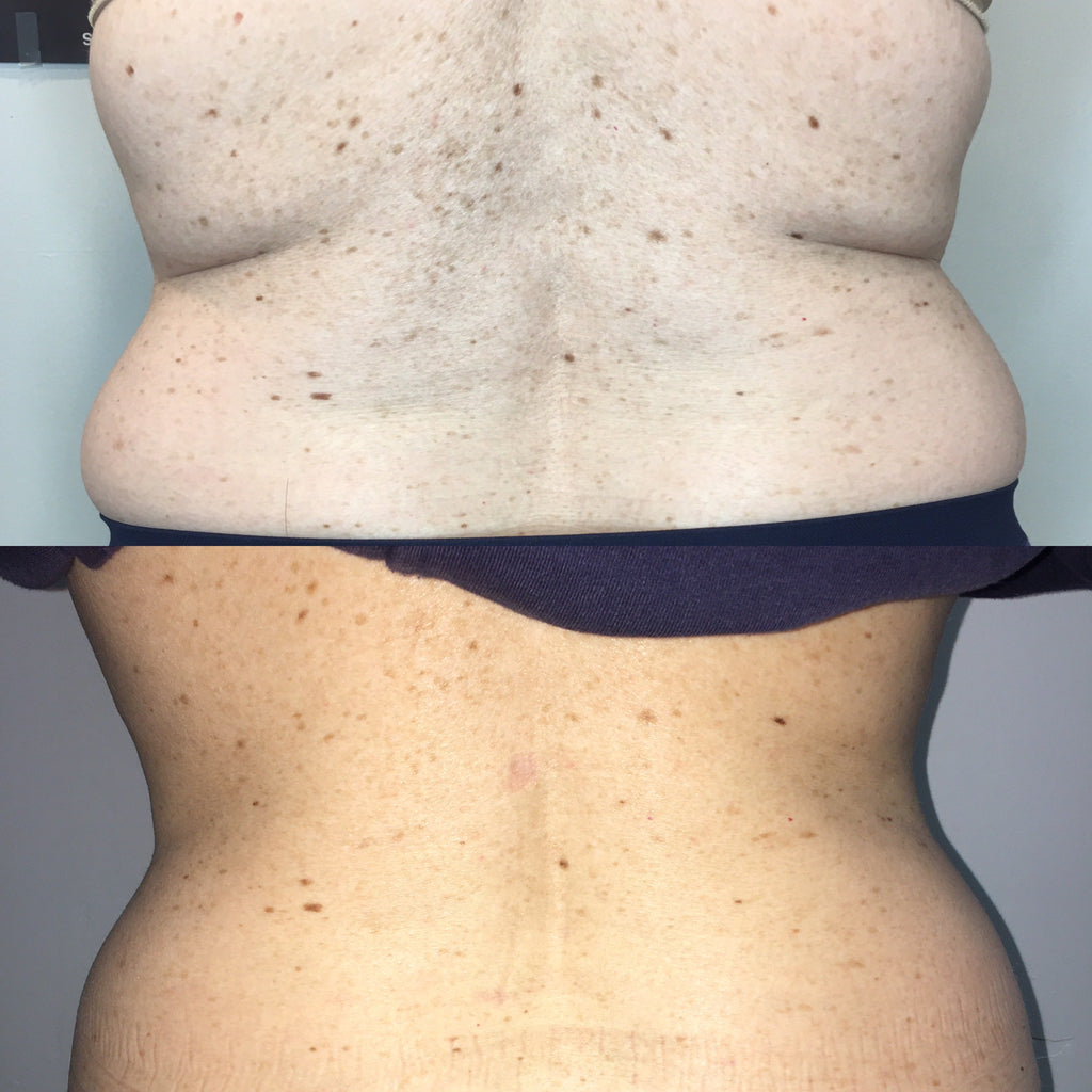 10 Body Thermal Sculpting (T-Schock). DEAL OF THE YEAR!