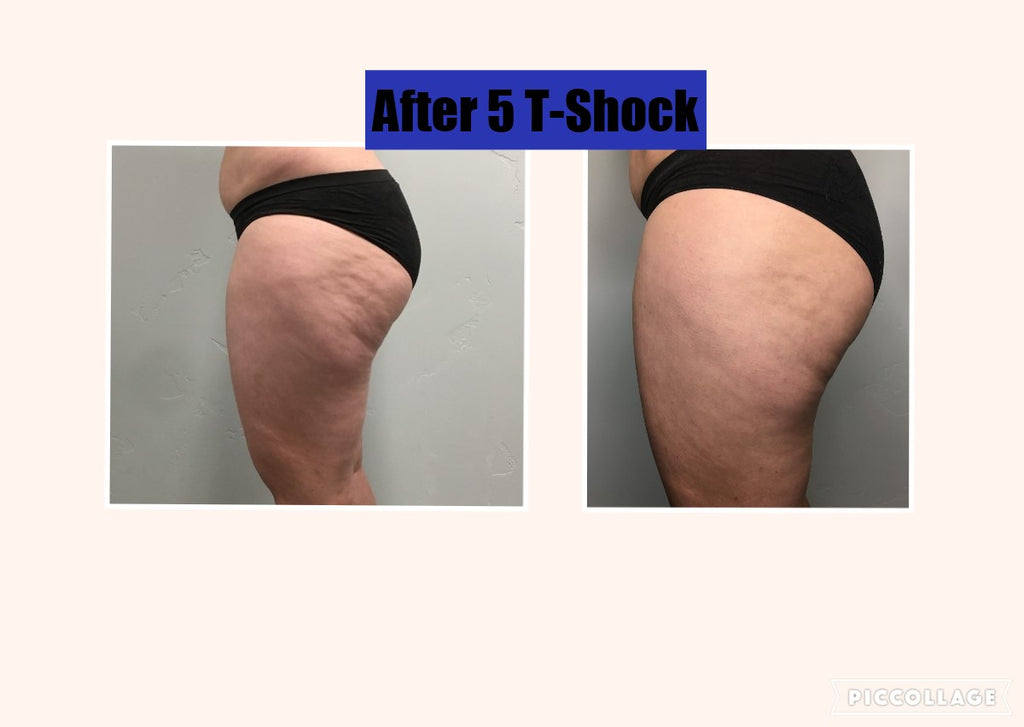 10 Body Thermal Sculpting (T-Schock). DEAL OF THE YEAR!